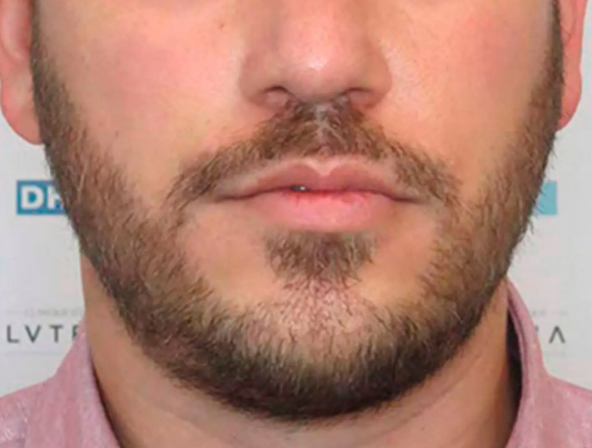 implante de barba - DHI