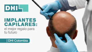 Implantes capilares: el mejor regalo para tu futuro.