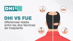 DHI vs FUE: técnicas de implantación capilar explicadas