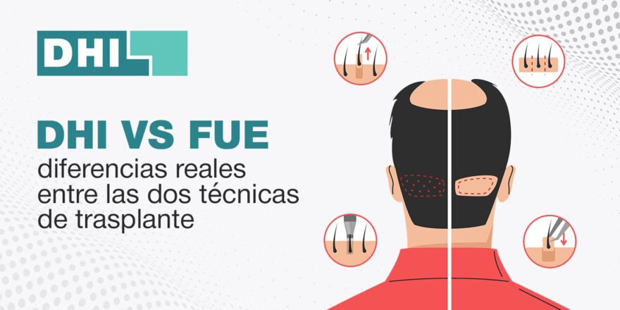 DHI vs FUE: técnicas de implantación capilar explicadas