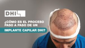 Así es el proceso de un implante capilar: paso a paso y sin filtros