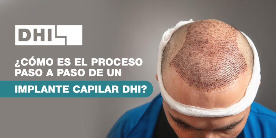 Así es el proceso de un implante capilar: paso a paso y sin filtros