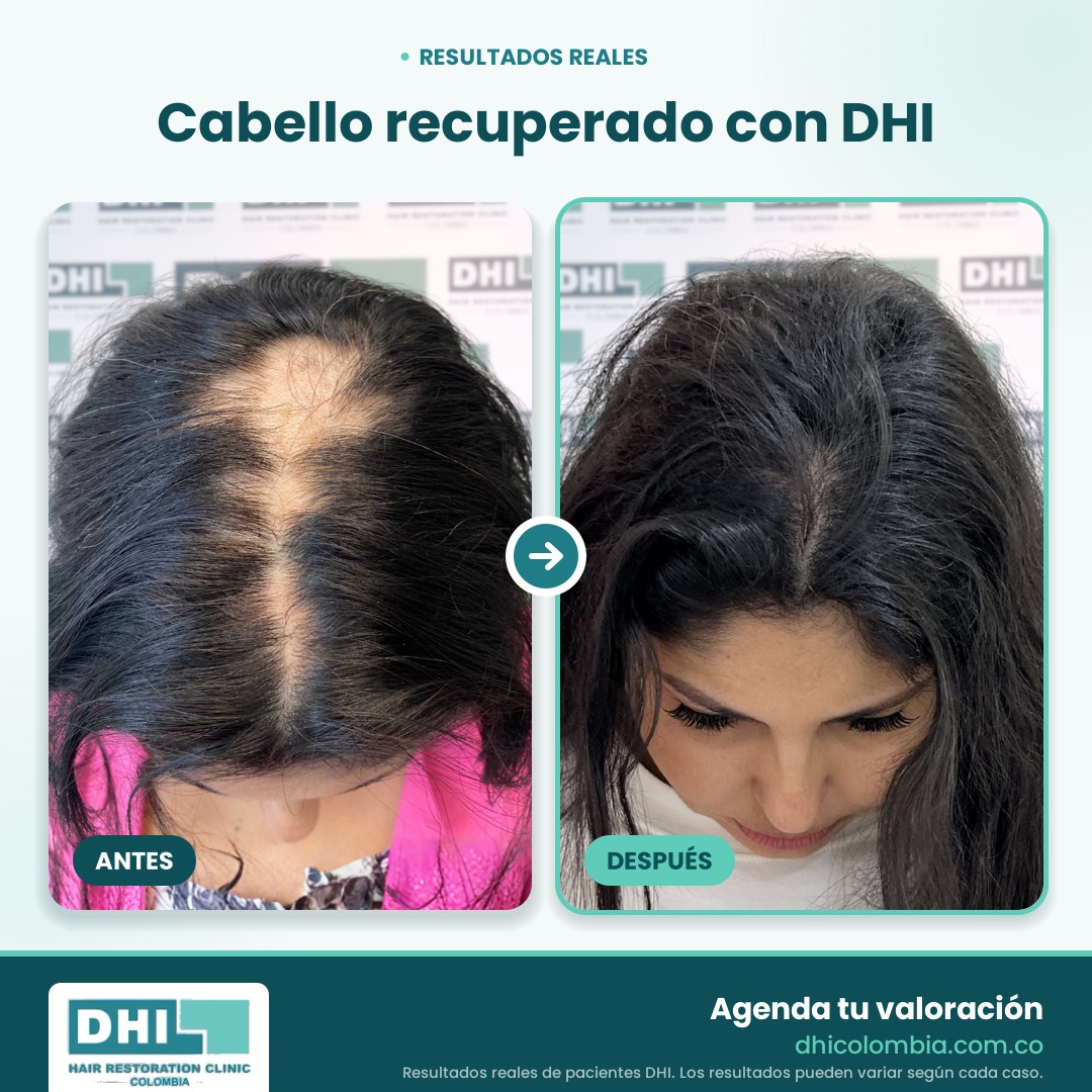 DHI_Antes_Despues_Web_1