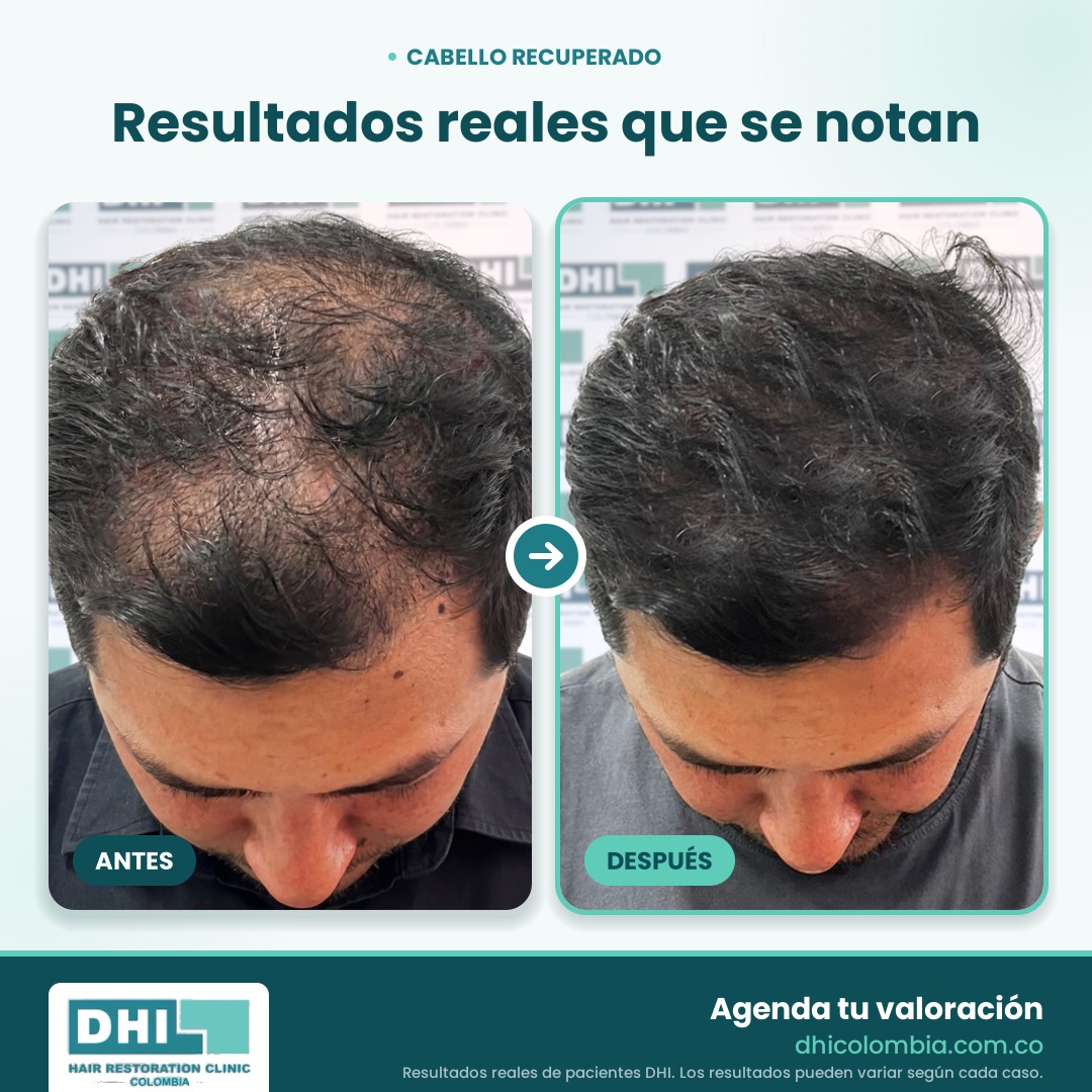 DHI_Antes_Despues_Web_3